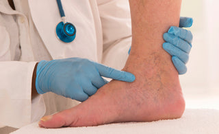 Varicose veins